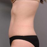 Tummy Tuck Before & After Patient #436