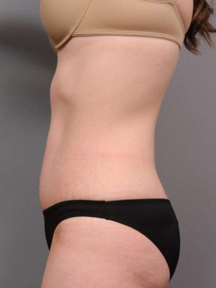 Tummy Tuck Before & After Patient #436
