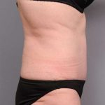 Tummy Tuck Before & After Patient #450