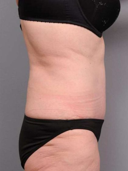 Tummy Tuck Before & After Patient #450