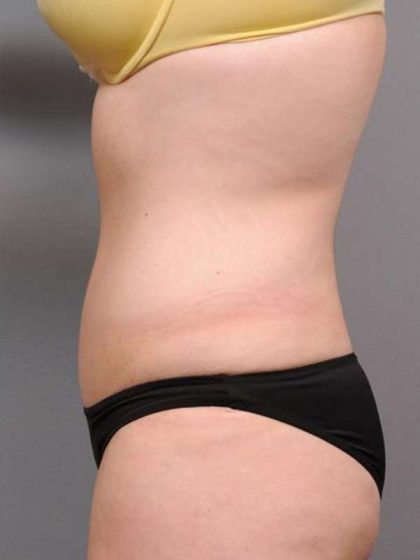 Tummy Tuck Before & After Patient #463
