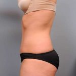 Tummy Tuck Before & After Patient #474