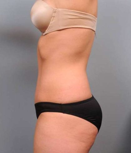 Tummy Tuck Before & After Patient #474