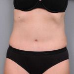 Tummy Tuck Before & After Patient #497