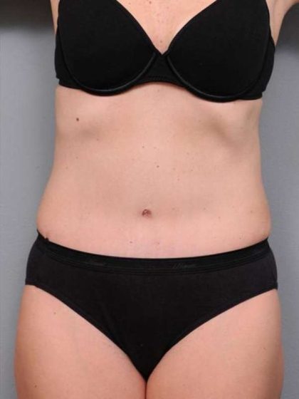 Tummy Tuck Before & After Patient #497