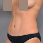 Tummy Tuck Before & After Patient #504