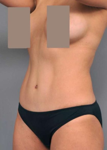 Tummy Tuck Before & After Patient #504