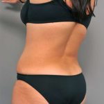 Tummy Tuck Before & After Patient #515