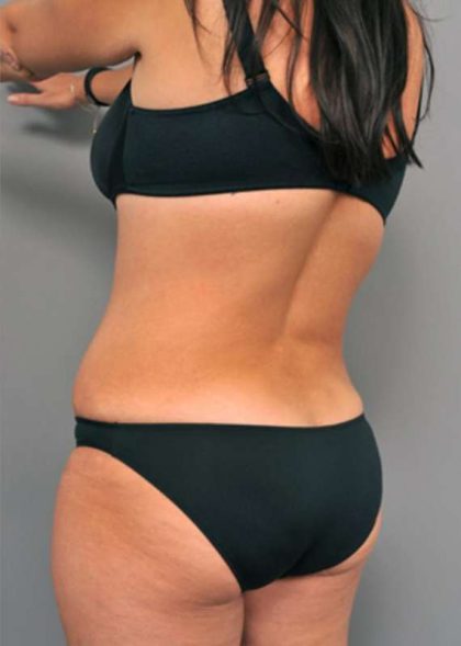 Tummy Tuck Before & After Patient #515