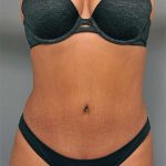 Tummy Tuck Before & After Patient #522