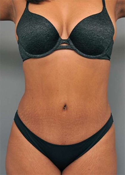 Tummy Tuck Before & After Patient #522