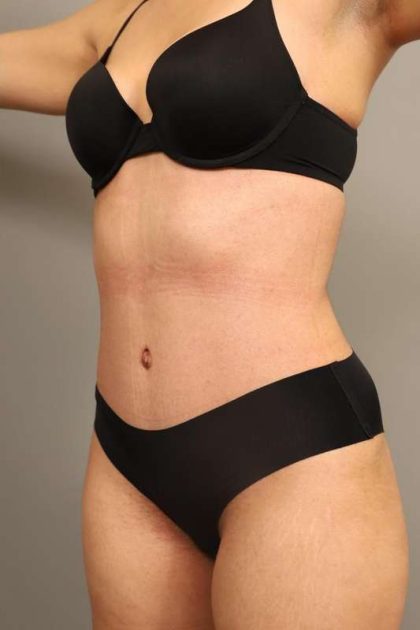 Liposuction Before & After Patient #550