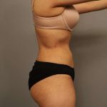 Liposuction Before & After Patient #563