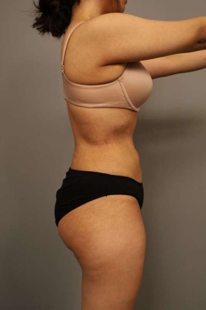 Liposuction Before & After Patient #563