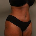 Tummy Tuck Before & After Patient #574