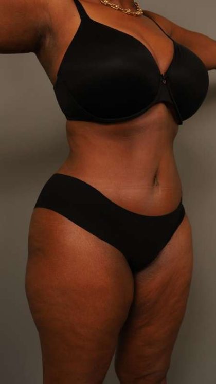 Tummy Tuck Before & After Patient #574