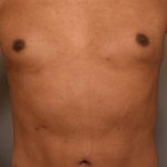 Liposuction Before & After Patient #581