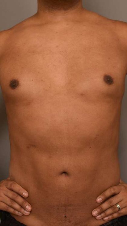 Liposuction Before & After Patient #581