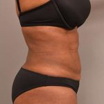 Liposuction Before & After Patient #604