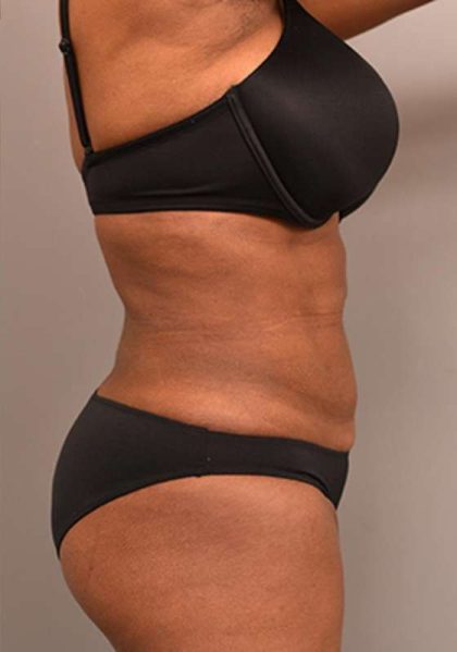 Liposuction Before & After Patient #604