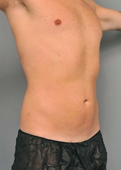 Liposuction Before & After Patient #611