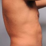 Liposuction Before & After Patient #626