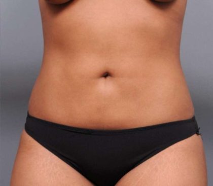 Liposuction Before & After Patient #635