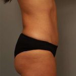Tummy Tuck Before & After Patient #260