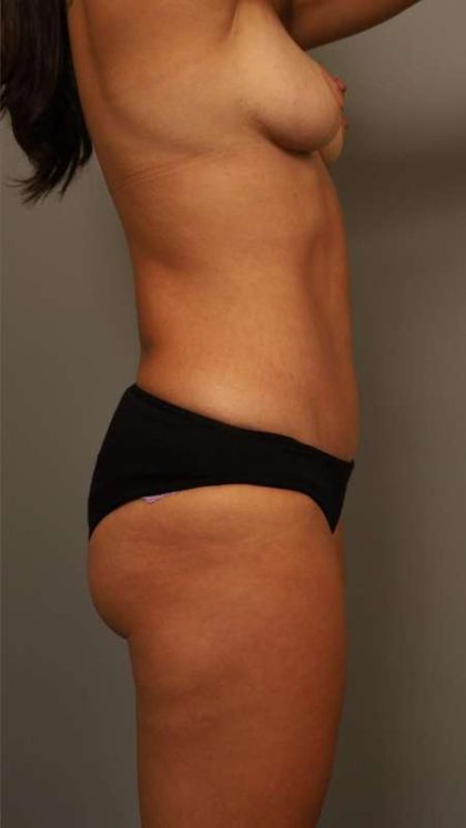 Tummy Tuck Before & After Patient #260