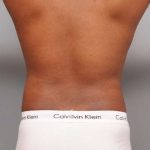 Liposuction Before & After Patient #648