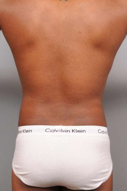 Liposuction Before & After Patient #648