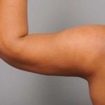 Liposuction Before & After Patient #655