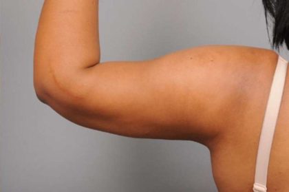 Liposuction Before & After Patient #655