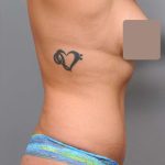 Liposuction Before & After Patient #662