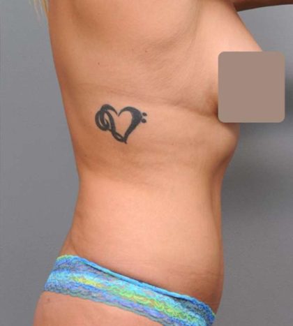 Liposuction Before & After Patient #662