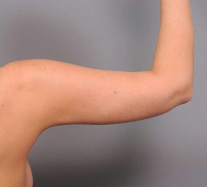 Liposuction Before & After Patient #669