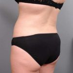Liposuction Before & After Patient #681