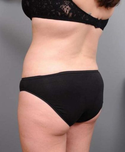 Liposuction Before & After Patient #681
