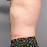 Liposuction Before & After Patient #688