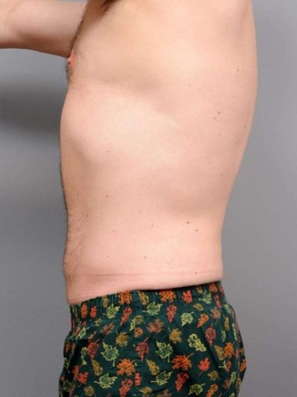 Liposuction Before & After Patient #688