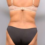 Liposuction Before & After Patient #695