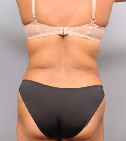 Liposuction Before & After Patient #695