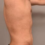 Liposuction Before & After Patient #704