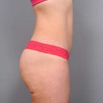 Liposuction Before & After Patient #716