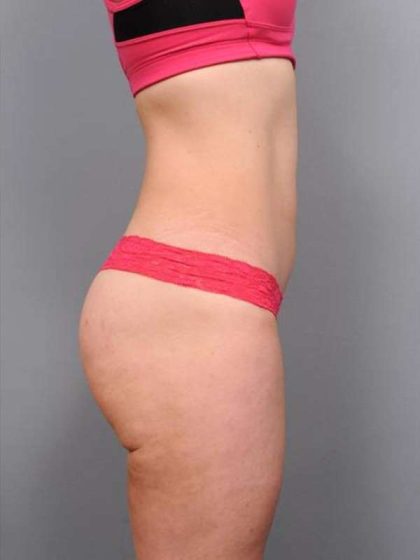 Liposuction Before & After Patient #716