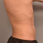 Liposuction Before & After Patient #749