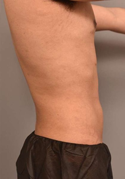 Liposuction Before & After Patient #749