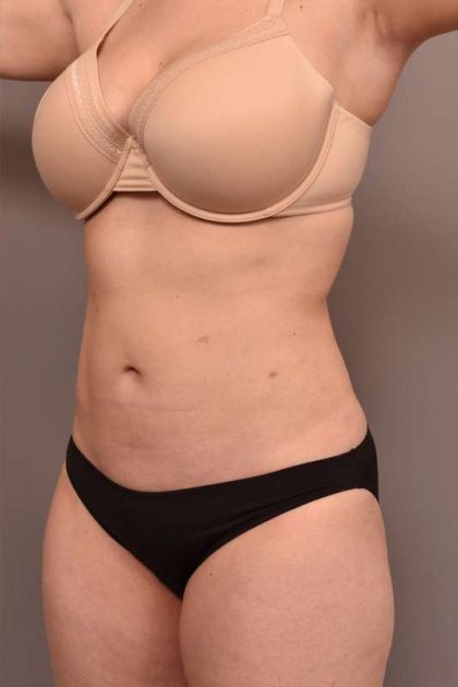 Liposuction Before & After Patient #756