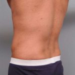 Liposuction Before & After Patient #783
