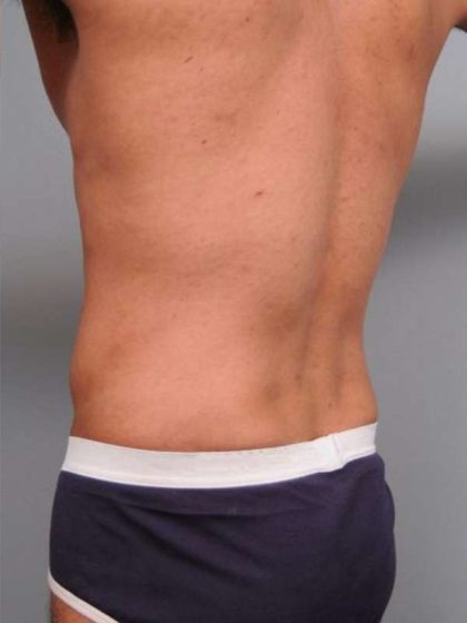 Liposuction Before & After Patient #783
